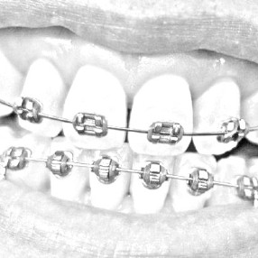 Affordable braces in Melbourne eastern suburbs